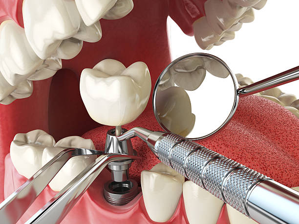 Best Emergency Tooth Extraction in Gleason, TN
